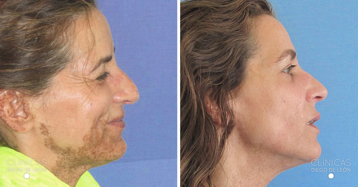 Eliminar manchas cara - Antes y después - Láser Fraxel