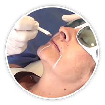marcacion laser fraxel laser fraxel marcacion