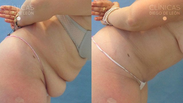 Abdominoplastia fotos