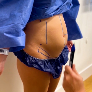 cirugía de abdominoplastia