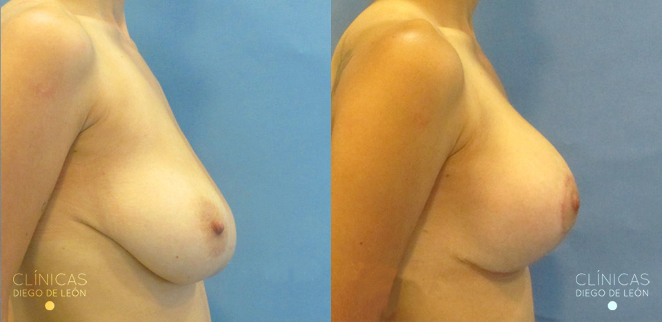 Mastopexia con implantes resultados | ClÃnicas Diego de León