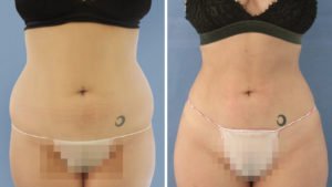 Marichu del Amo: antes y después de lipoescultura