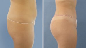 Marichu del Amo: antes y después de lipoescultura