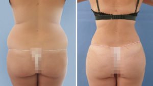 Marichu del Amo: antes y después de lipoescultura