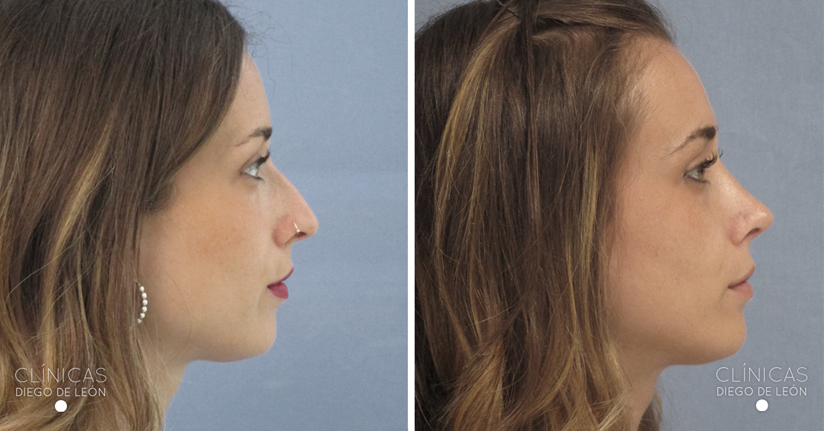 Antes y después rinoplastia