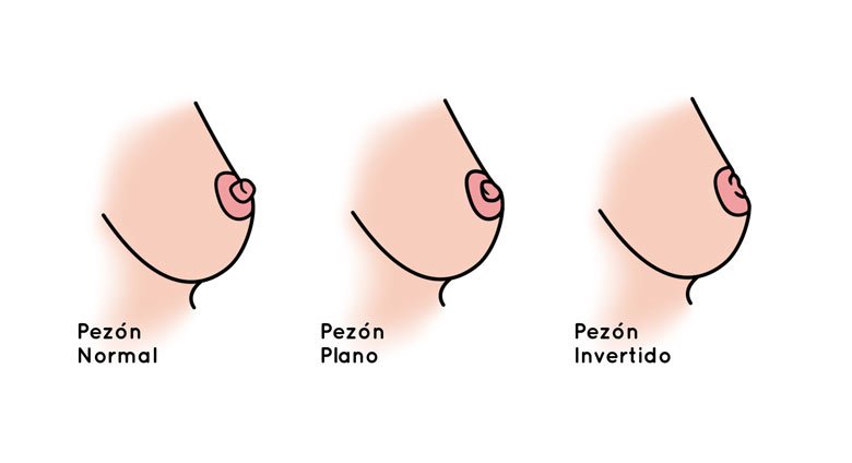 Pezón Invertido