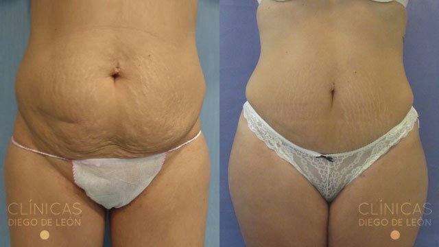 Tratamiento de abdominoplastia