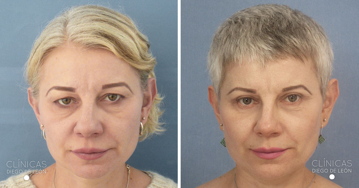 Cirugía de ojos resultados