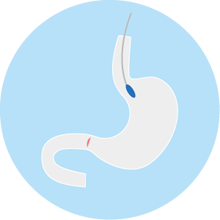 balon gastrico colocacion