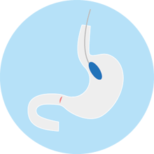 colocacion de balon gastrico