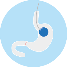 balon intragastrico inflado