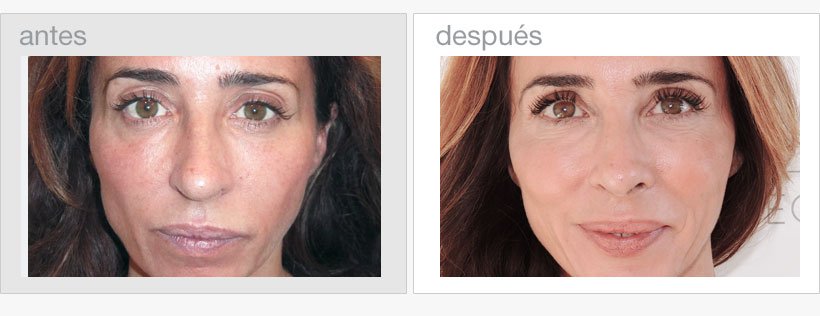 Operación de nariz de María Patiño