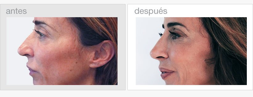 Rinoplastia de María Patiño antes y después