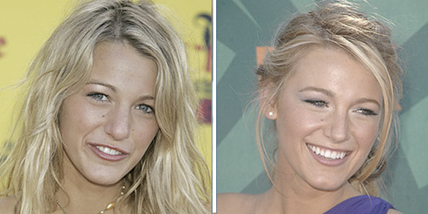Blake Lively cirugía de nariz