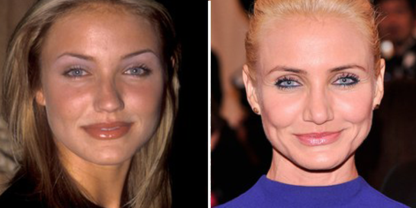 Cirugía Nariz de Cameron Diaz