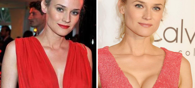 Operación de Senos Diana Kruger