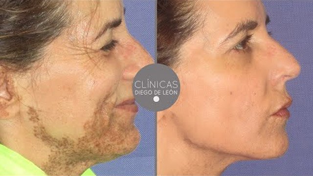 Eliminar manchas y marcas de la piel Inés