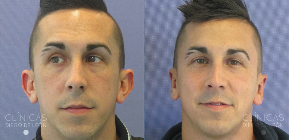 Otoplastia antes y después
