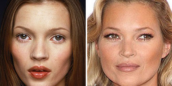 Operación de nariz Kate Moss
