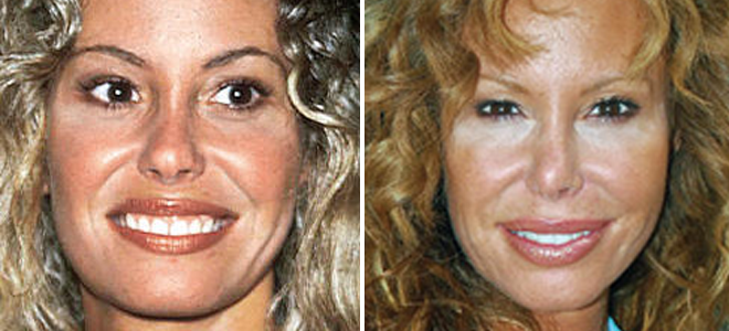 Operaciones estéticas de Lara Dibildos