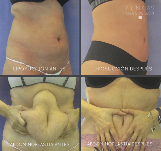 Liposuccion abdominal o abdominoplastia