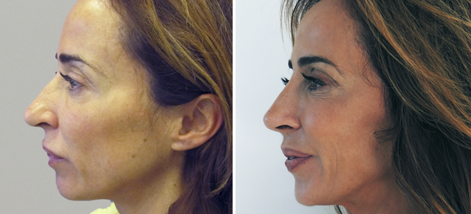 Cirugía de María Patiño