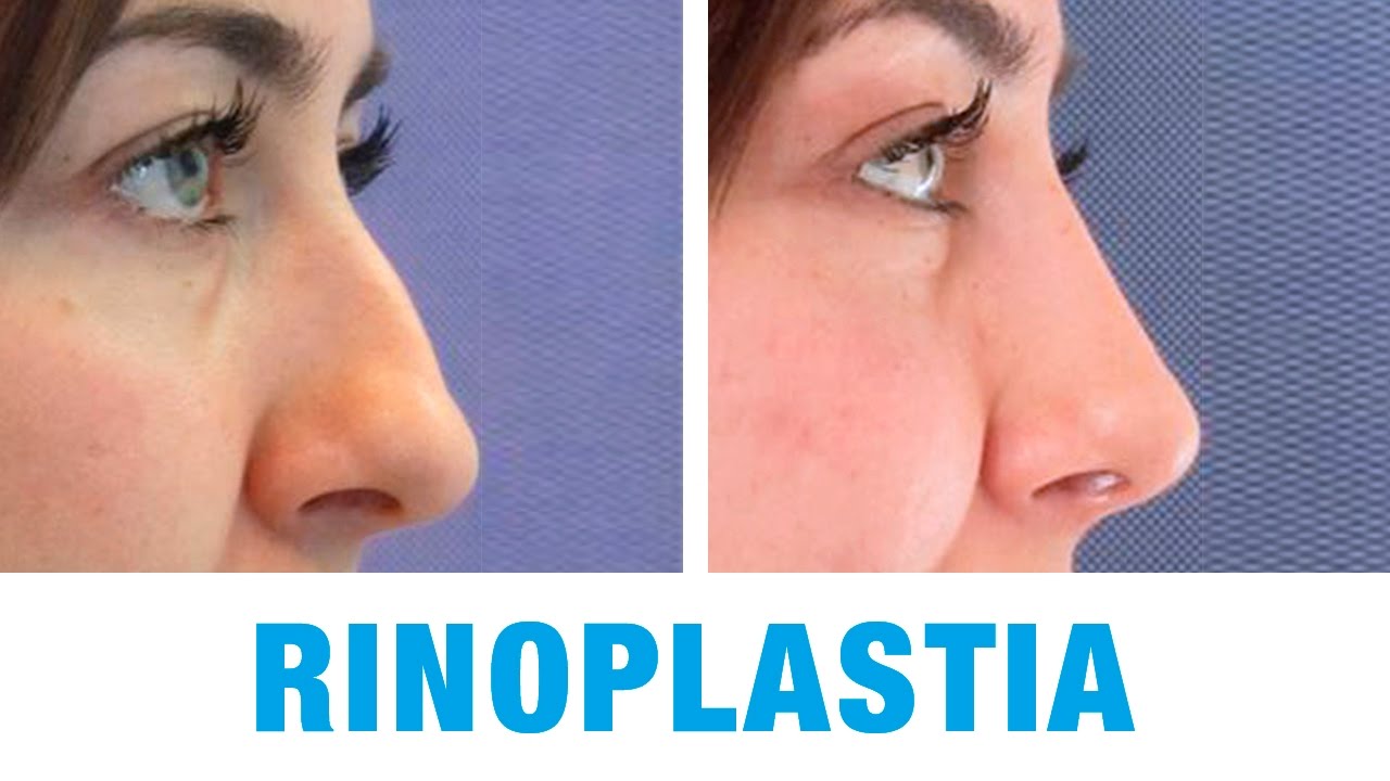 Rinoplastia de nariz Ana