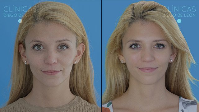 Mesoterapia facial antes y después