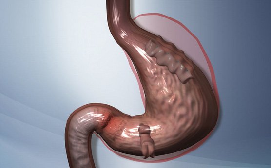 Método POSE - Reducción de estómago sin cirugía