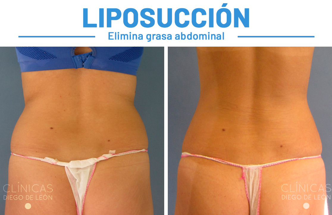Liposucción Diana
