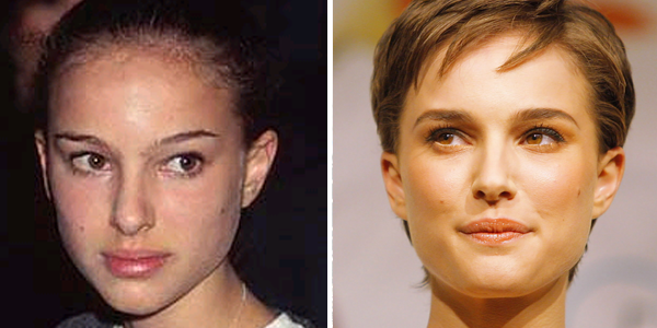 Operación de nariz Natalie Portman