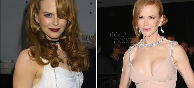 Cirugía de senos Nicole Kidman