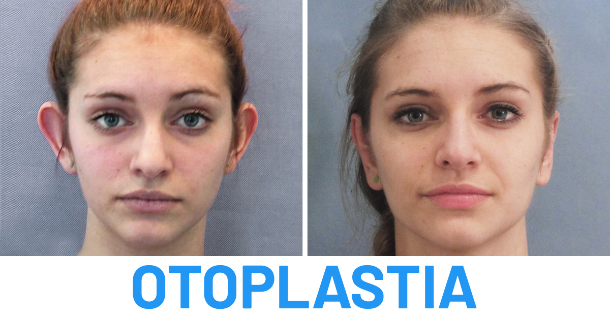 Otoplastia bilateral Sofia