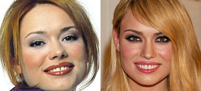 Operación de nariz de Patricia Conde