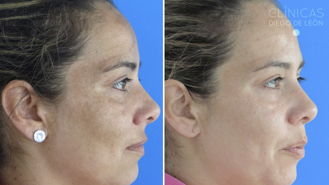 peeling antes y despues