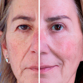 Blefaroplastia completa