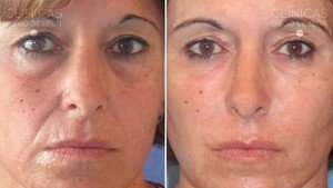 Rellenos de Surcos Nasogenianos