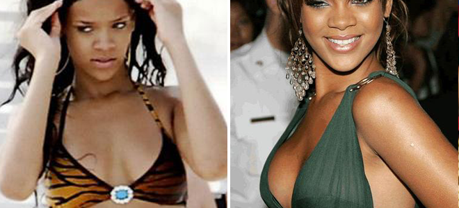 Operación de senos de Rihanna