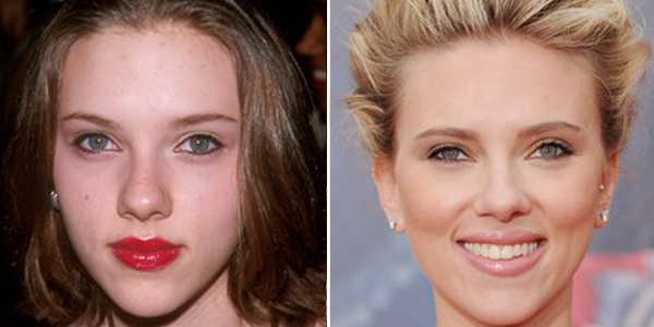 Scarlett Johansson operación de nariz