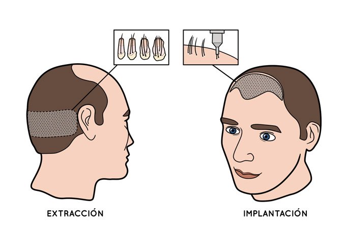 Transplante de pelo folicular