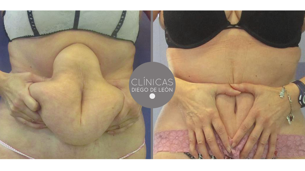 Abdominoplastia antes y después