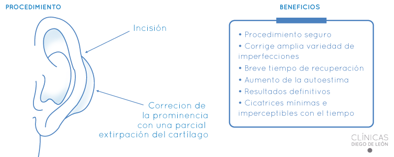 Procedimiento de la otoplastia