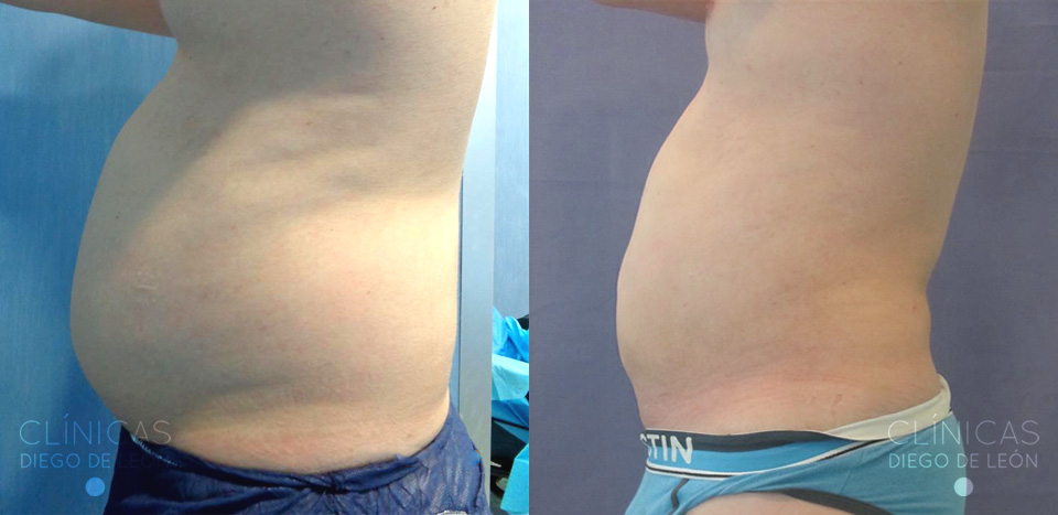 Antes y después Liposucción de abdomen y flancos