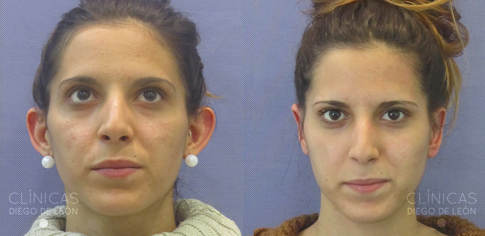 Antes y después Otoplastia
