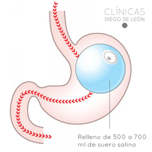 balon gastrico para bajar de peso