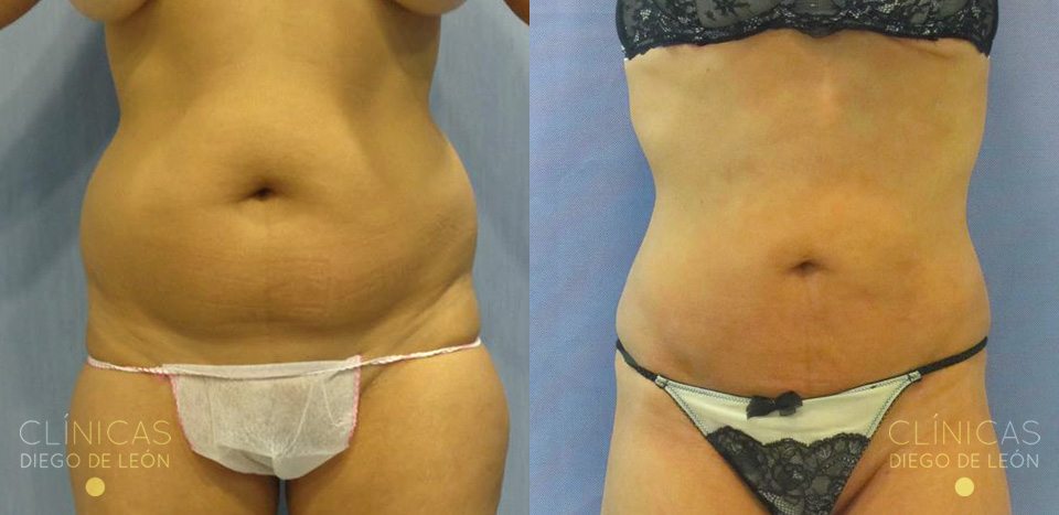 Antes y después Liposucción de abdomen