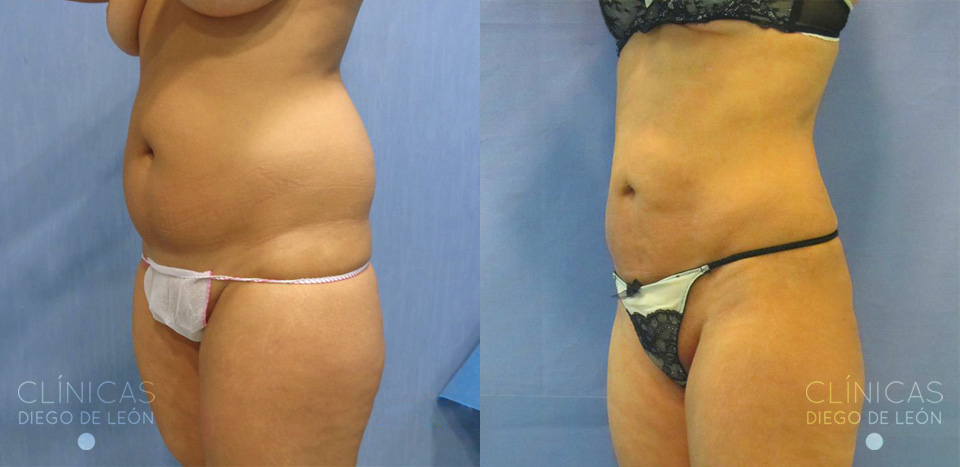 Resultados de liposucción de abdomen