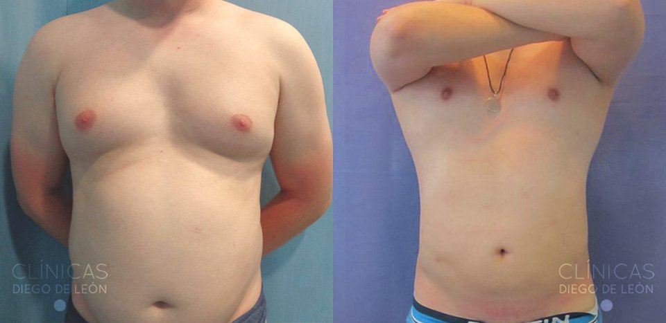 Resultados Liposucción abdomen y flancos
