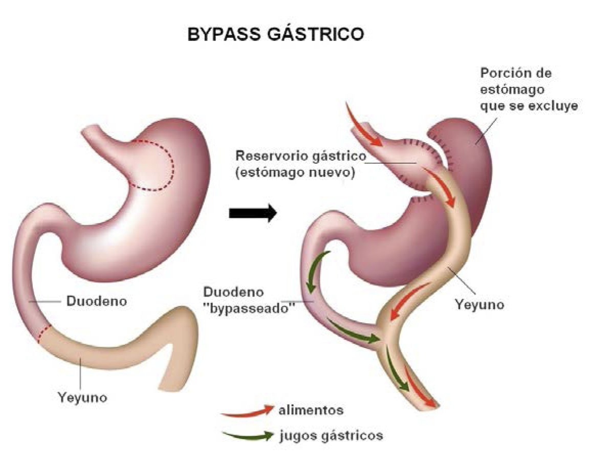 bypass gastrico