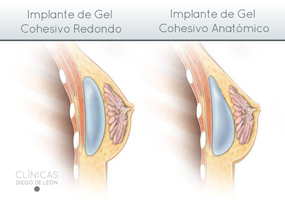tipos de implantes mamarios